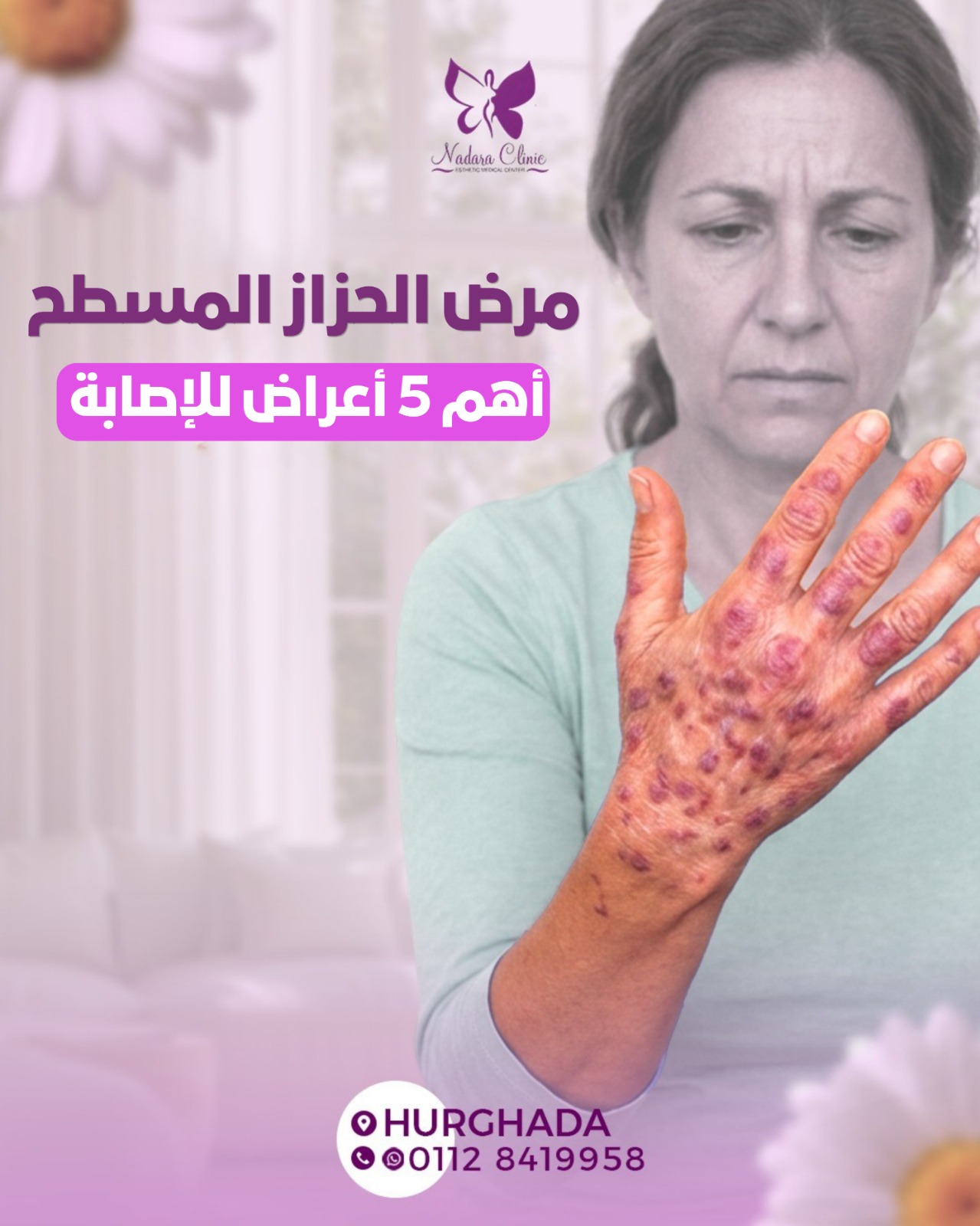 مرض الحزاز المسطح أهم 5 أعراض للاصابة في الغردقة